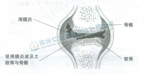 滑膜炎的原因