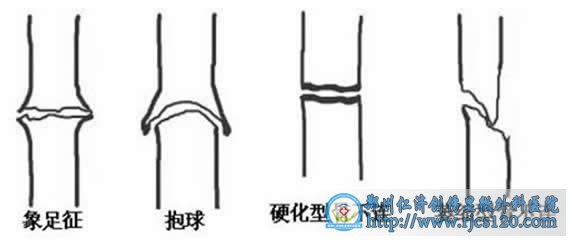 骨不連的病因